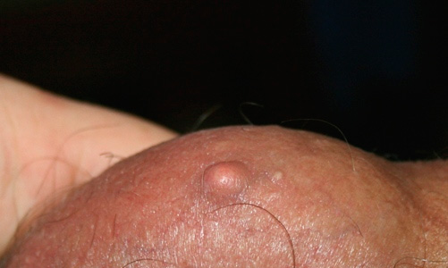 Воспаление сальной железы в паху у женщин лечение thumbnail